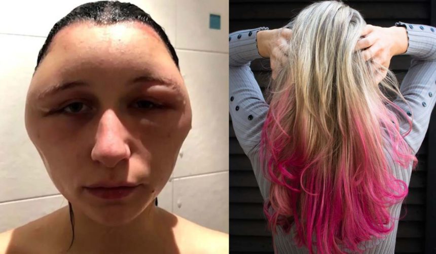 Side Effects Of Hair Dying